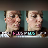 Embracing PCOS: Challenging Beauty Norms