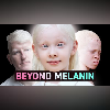 How Albinism Affects Skin, Hair, and Vision