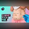 The Tummy Tuck Tale: A Story of Surgical Woes