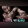 Exploring Vitiligo: Is a Cure Possible?